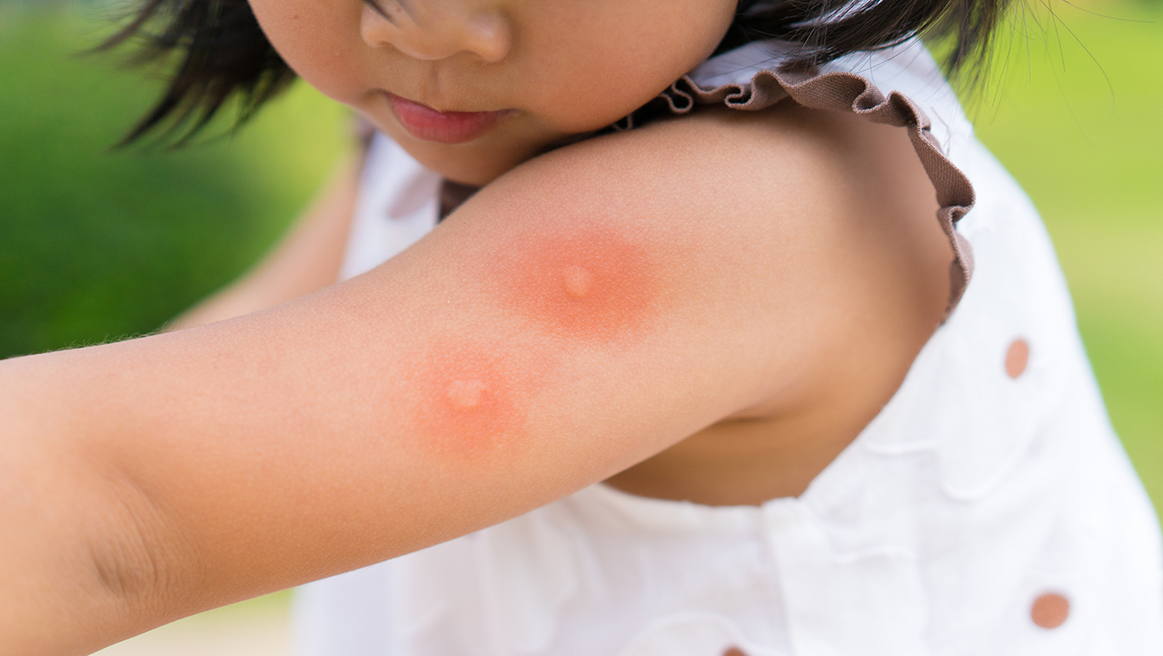 Alergia a Picada de Mosquito: causas, sintomas e tratamento