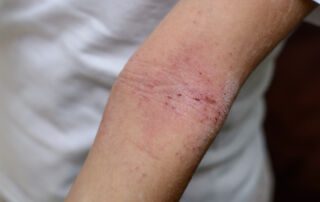 Dermatite atópica
