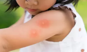 alergia inseto